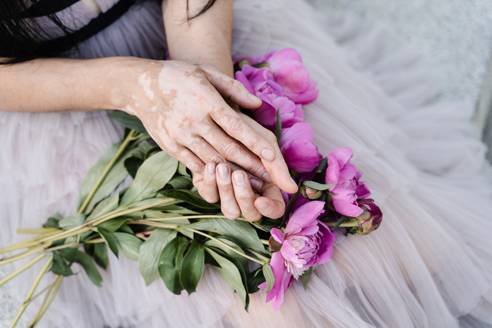 Hands with vitiligo skin pigmentation and bouquet of flowers peonies